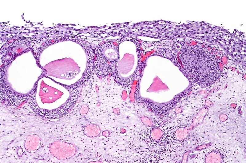 Urothelial carcinoma in situ in the setting of cystitis cystica et glandularis